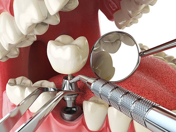 Best Chipped Tooth Repair Near Me  in Forest Park, OH